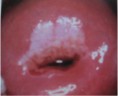 /album/fotogaleria-colposcopia/nic-ii-o-displasia-moderada-jpg/